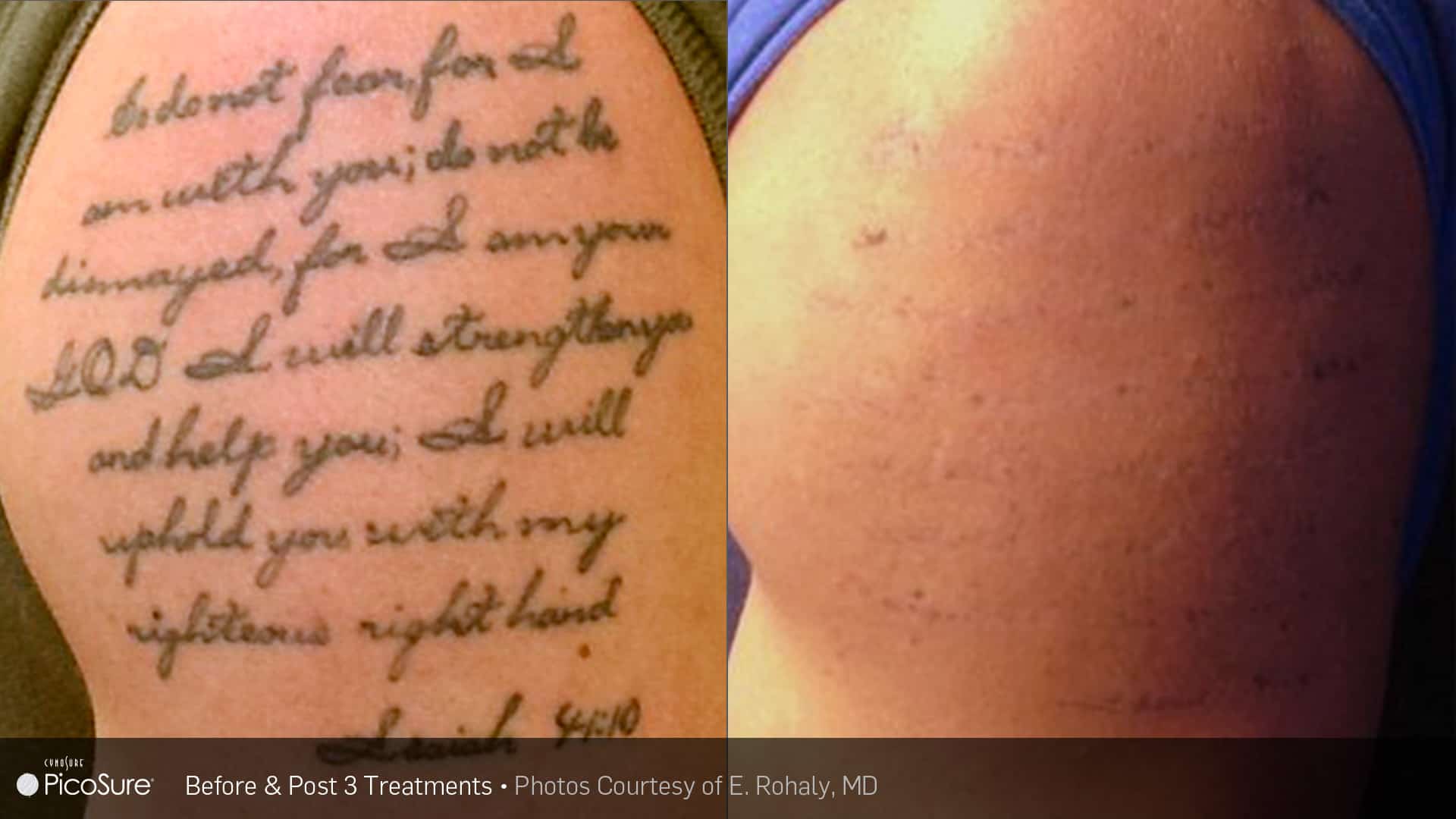 Zapp Laser Studio  After just ONE PicoSure Laser Treatment PocoSure    PicoSure Tattoo Removal  Fading for a cover up  1st  Treatment  Treatment took 10 minutes  Discomfort