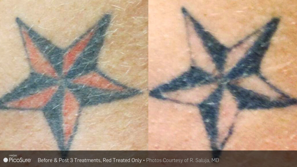 tattoo removal