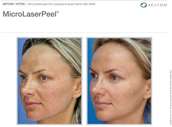 Sciton MicroLaserPeel®