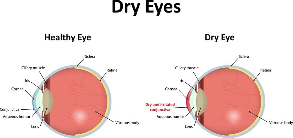 Dry Eye Causes Diagram in Atlanta