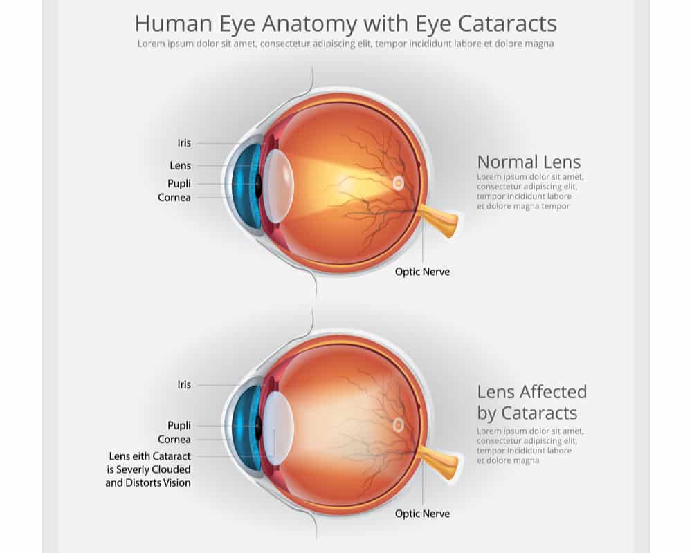 Human Anatomy with Cataract in Atlanta