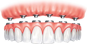 Illustration of full arch supported by implants