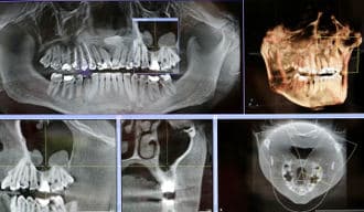 State-of-the-art Implant Treatment Planning