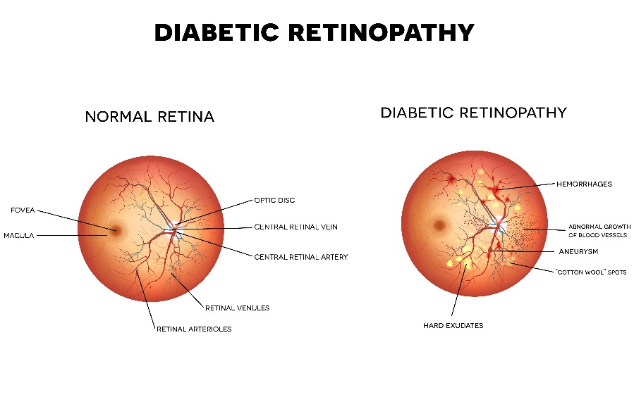 RETINAL CONDITION TREATMENT IN BOSTON