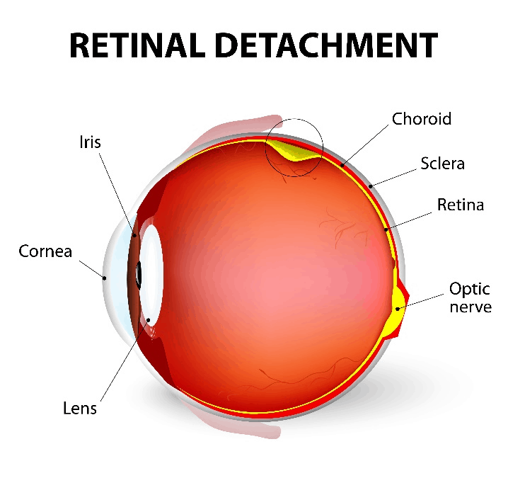 Retinal Condition Treatment - Boston Eye Physicians and Surgeons