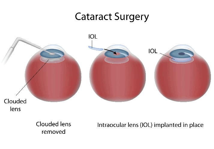 Cataract Surgery Infographic - Boston Eye Physicians and Surgeons