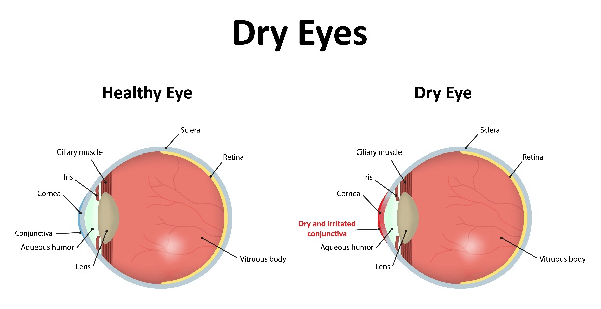 Dry Eye Infographic - Boston Eye Physicians & Surgeons