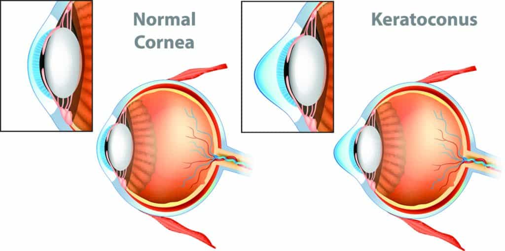 Life With Keratoconus Causes Symptoms And Treatments Boston 