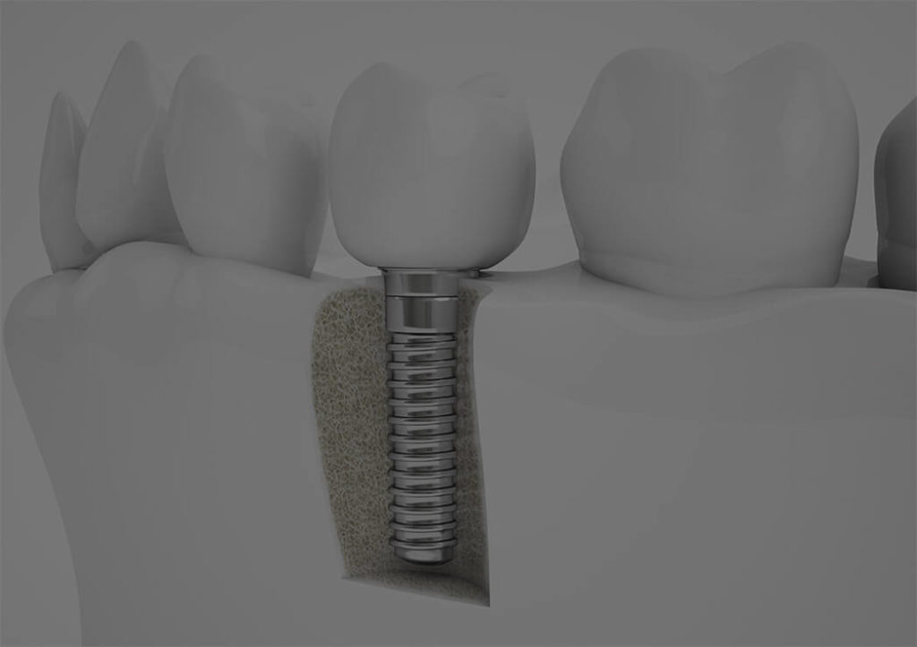 Dental Implants York County