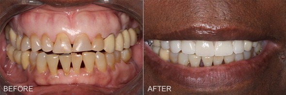 Smile Makeover Hellam