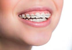 Traditional Orthodontics York County