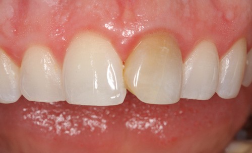 Before Fixing a Discolored Tooth