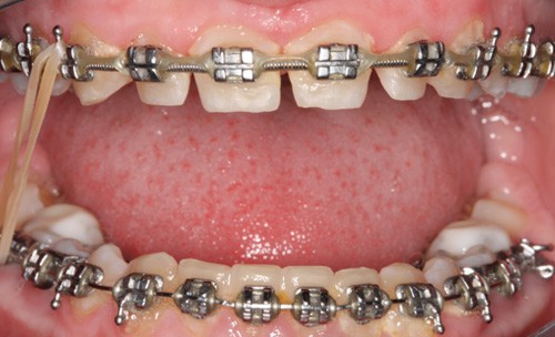 Combining Orthodontics & Cosmetic Dentistry York County