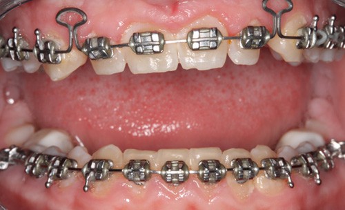 Before Combining Orthodontics and Cosmetic Dentistry