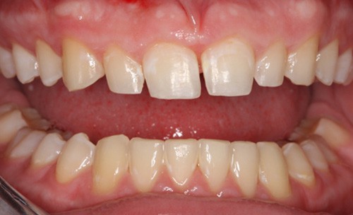 After Combining Orthodontics and Cosmetic Dentistry York County