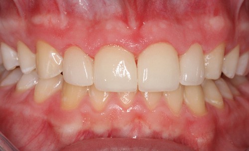 After Combining Orthodontics and Cosmetic Dentistry