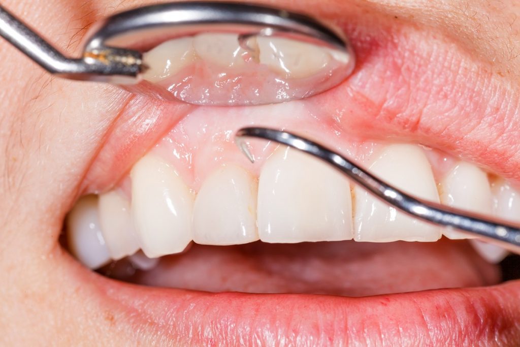 Signs and symptoms of gum disease