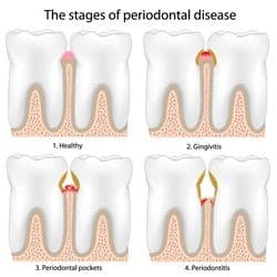Stages of Periodontal Disease York, PA