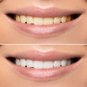 Dr. Gordon Bell explains what professional teeth whitening can and cannot accomplish.