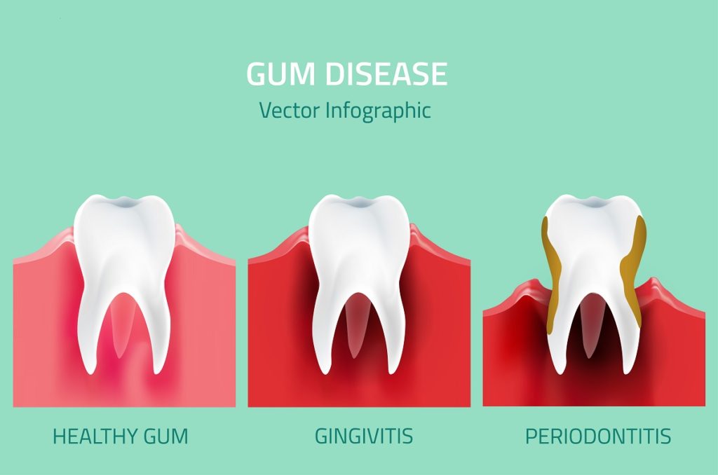 Periodontal (gum) disease tips and treatment Hellam