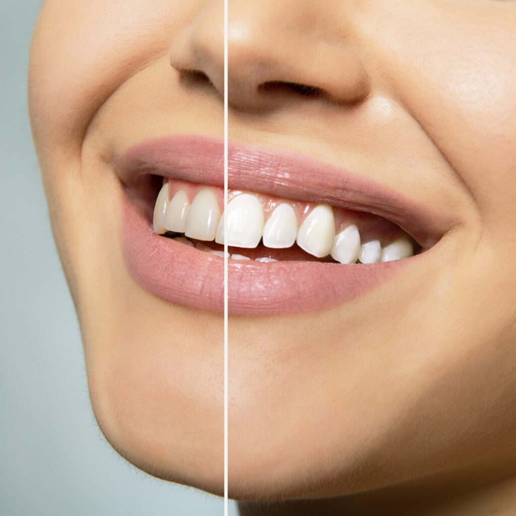 Teeth whitening in Hellam & York, PA
