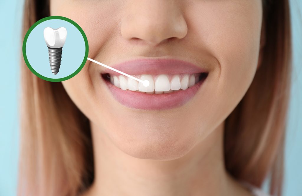 Orthodontics and Dental Implants: Aligning Teeth for Implant