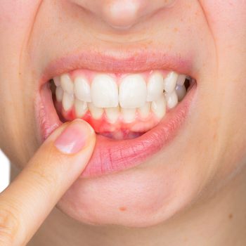 Gum disease treatment York dentist