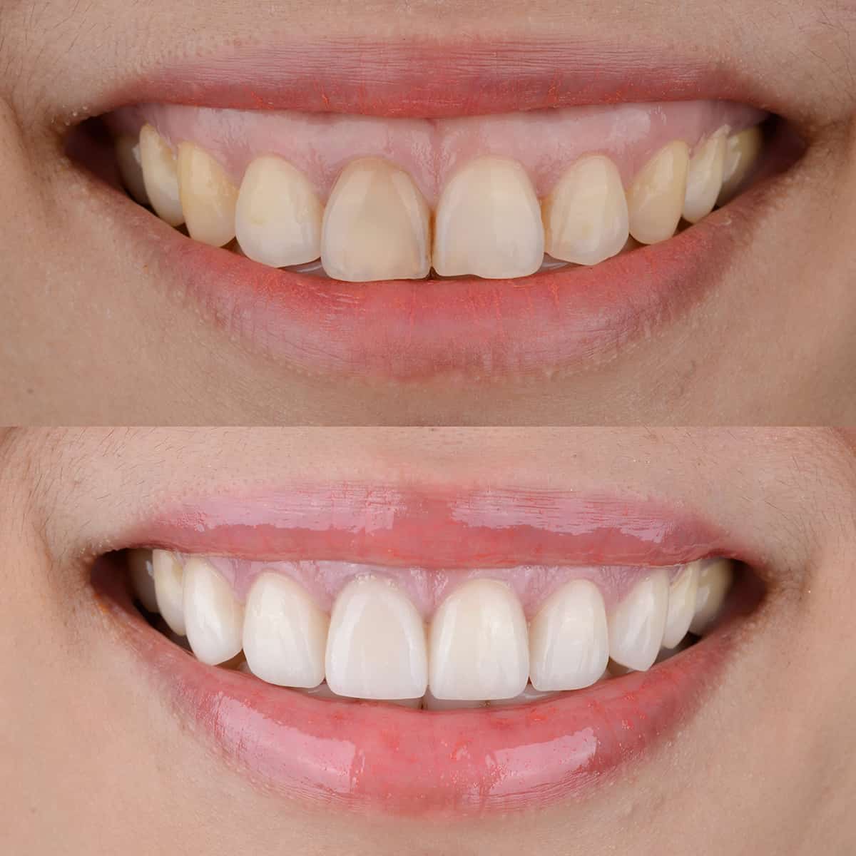 Laser Gum Contouring For a Gummy Smile Makes Teeth Appear Longer