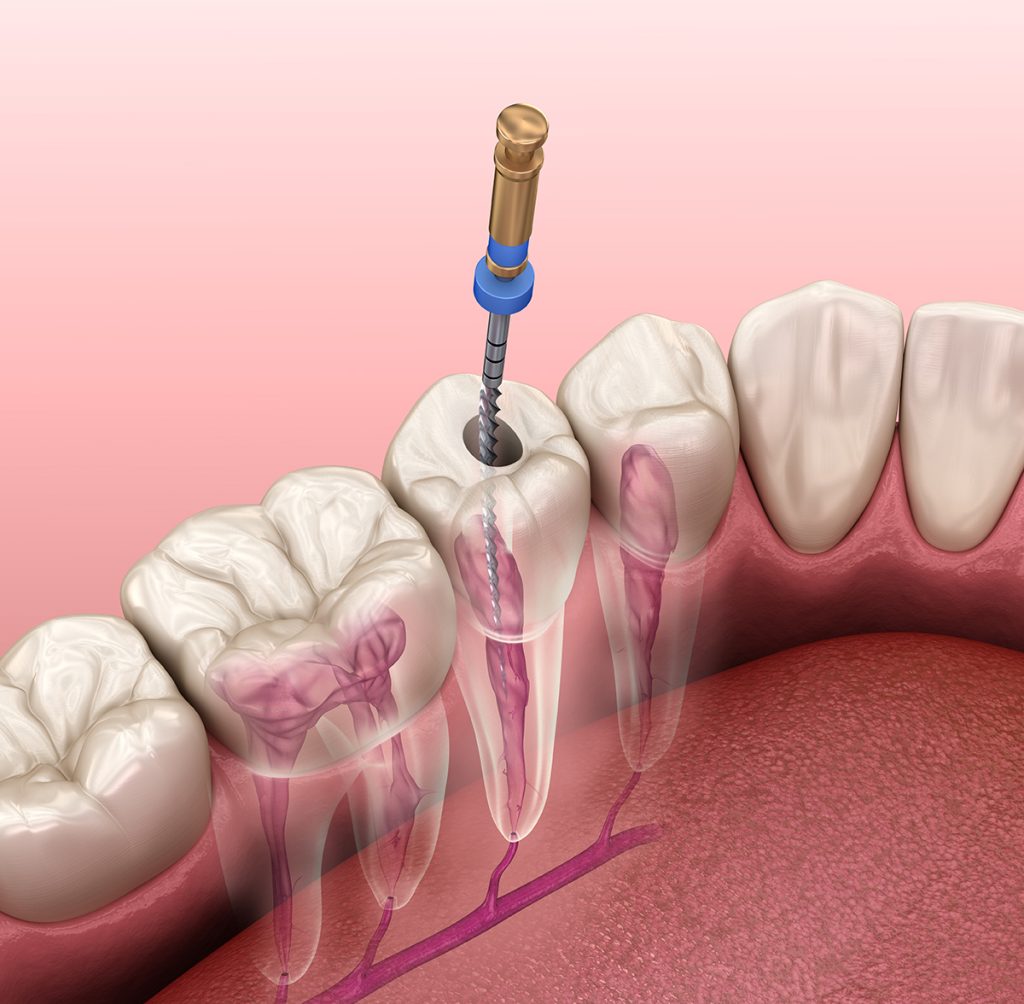 Root Canal Therapy Hellam PA