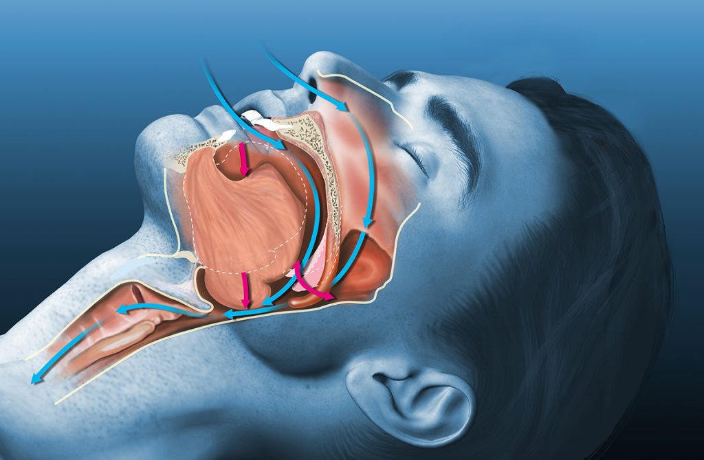 Sleep Apnea Hellman Township