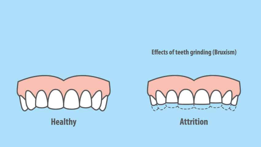 The Effects of Teeth Grinding