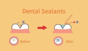 Dental sealants chatham