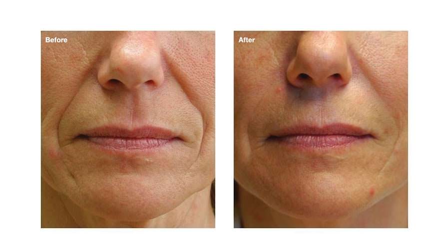 Non surgical facelift options B and A
