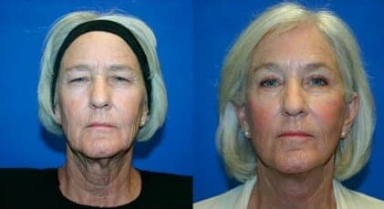 Fort Myers Eyelid Surgery Before and After