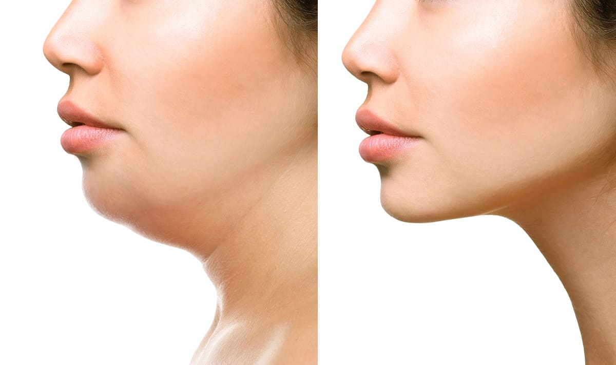 Non-Surgical Facial Rejuvenation in Fort Myers