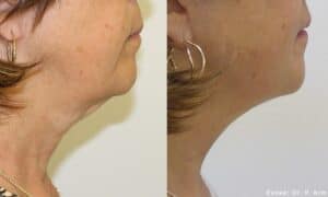 FACIAL REJUVENATION IN FORT MYERS