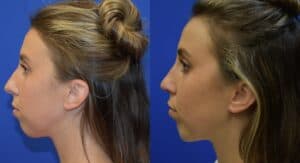 Rhinoplasty Before & After Photos