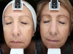 Intense Pulsed Light
Before & After Photos