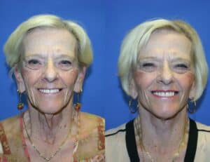 Laser Skin Resurfacing
Before & After Photos