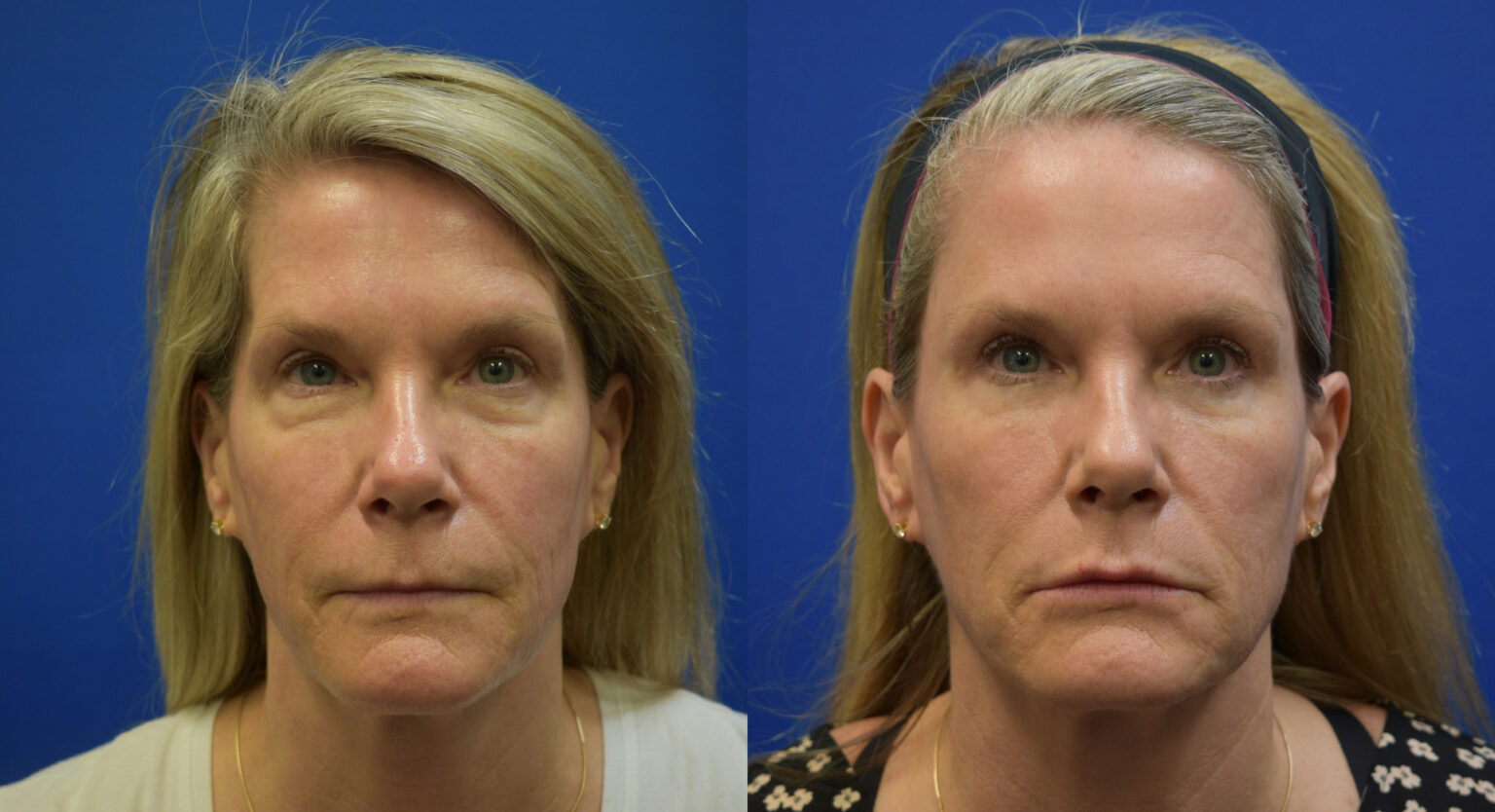 Bellafill Injections Fort Myers & Naples, FL Collagen Rejuvenation