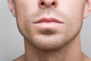 Chin Augmentation Estero