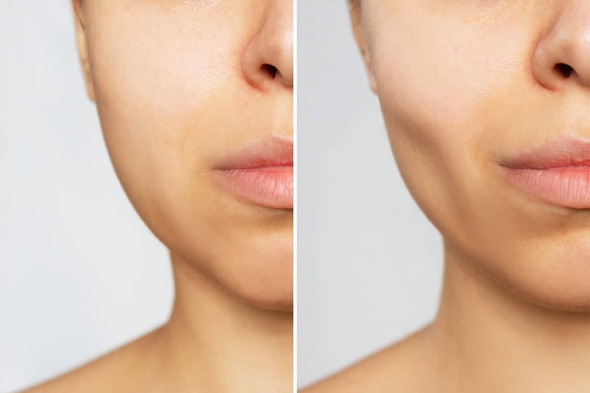 Chin & Cheek Augmentation in Fort Myers