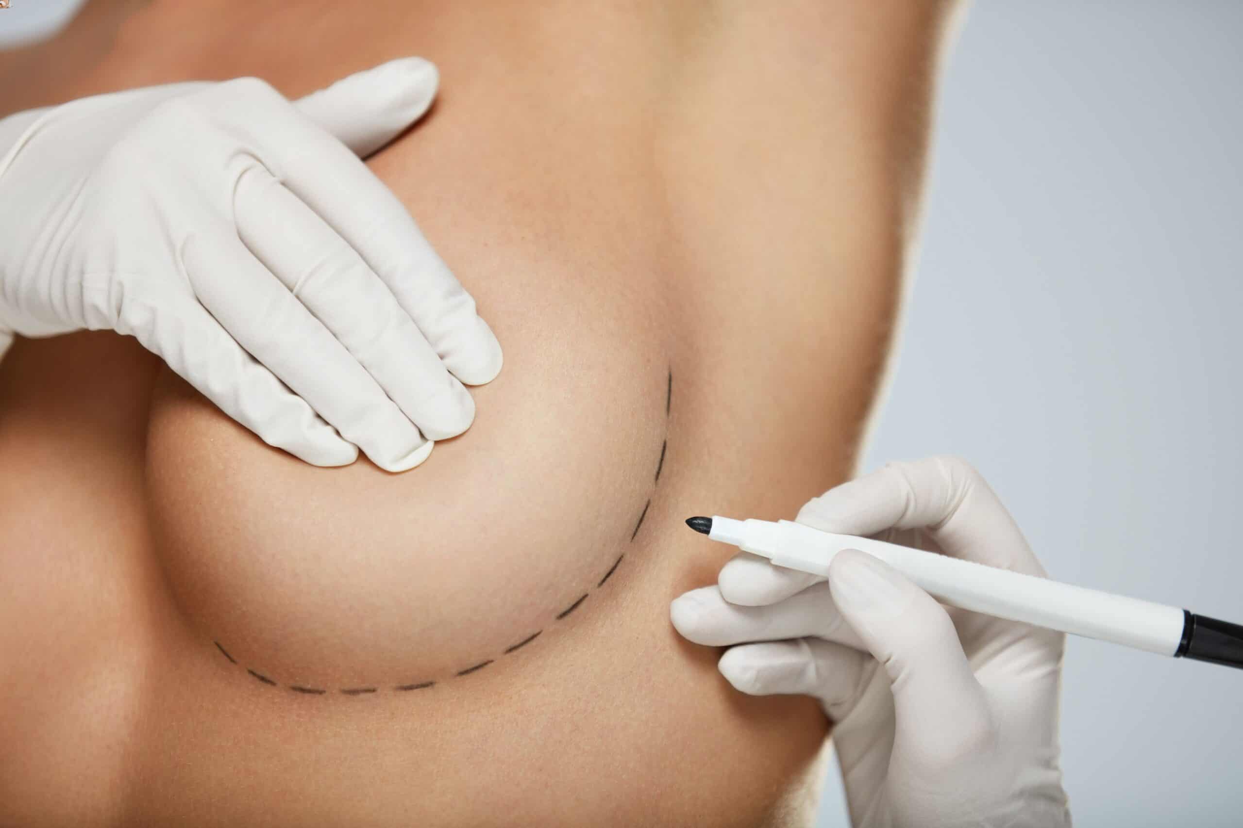 Should I Get Round or Shaped Breast Implants?