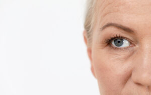Close up image of an attractive woman with sagging brows and eyelids before her combined brow lift and eyelid surgery