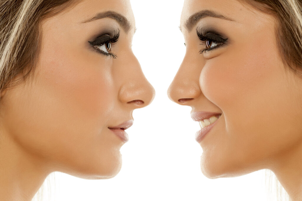 Two profile images of a woman, one before and one after plastic surgery