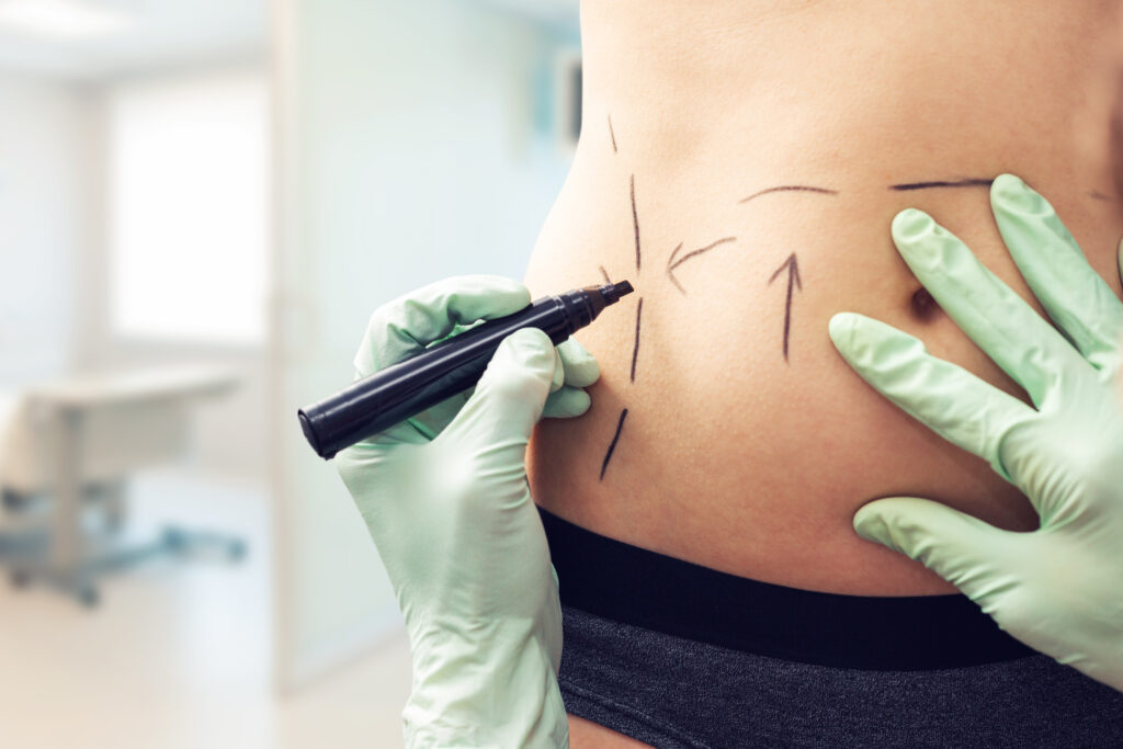 A doctor's gloved hands mark a patient's abdomen before tummy tuck surgery in Torrance.
