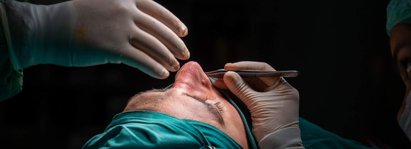 Male Rhinoplasty Procedure San Francisco CA