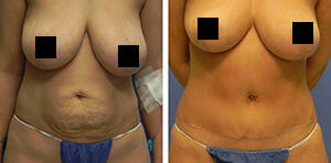 Before & after tummy tuck surgery patient