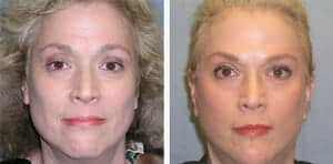 Before & after facelift patient