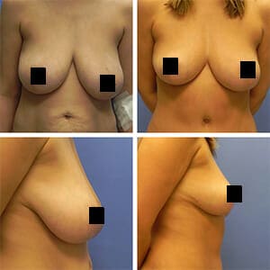 Before & after breast reduction patient